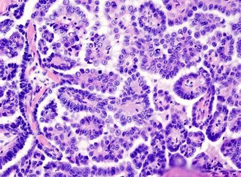 CancerRes：新研究发现帮助清除癌症干细胞的新靶标